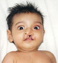 Cleft lip and/or palate